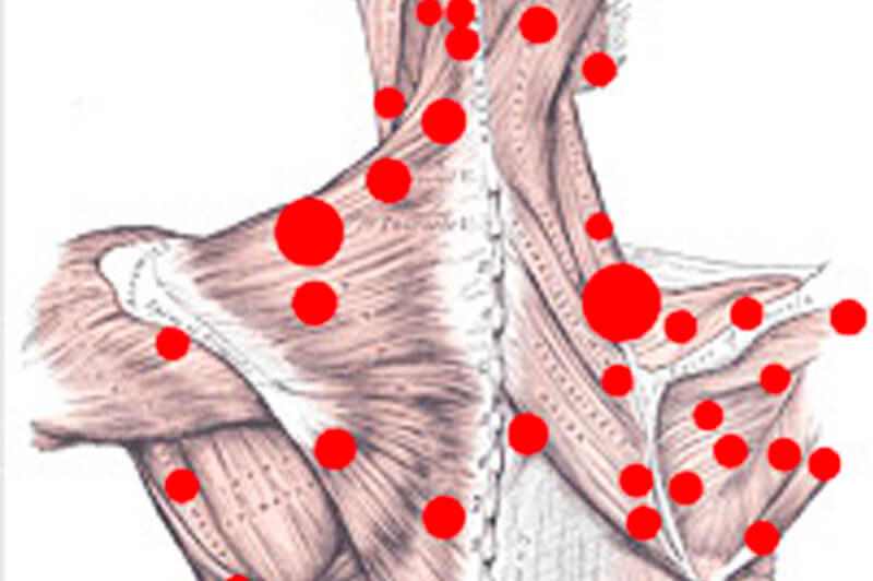 Triggerpoints - manuele compressie of dry needling