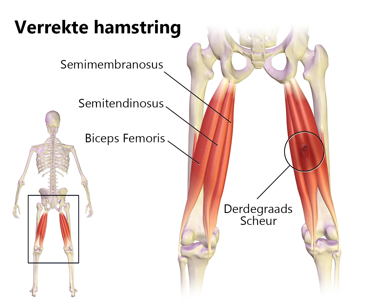 Hamstringblessure